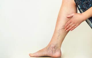 venous disease